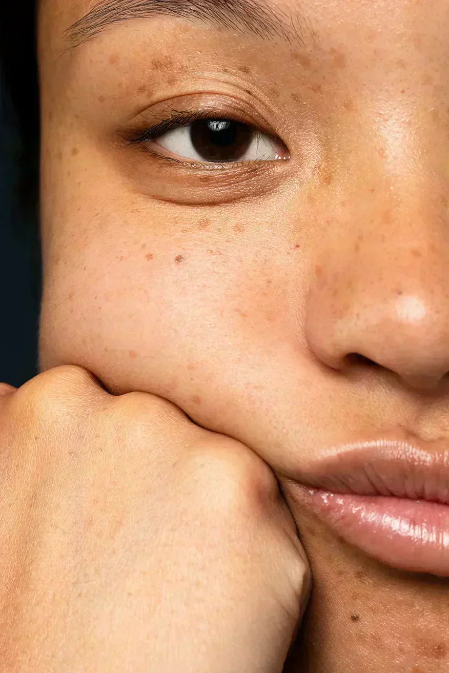 hyperpigmentation post inflammatoire causes traitement naturel